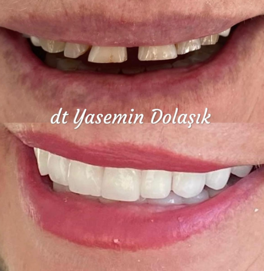Diastemalı dişlerde zirkonyum uygulaması
